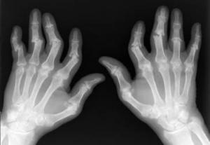 El parmaklarında bileklerde ağrı ve şişlik şikayetleriniz oluyorsa Romatoid Artrit (iltihablı el romatizması) olabilir
